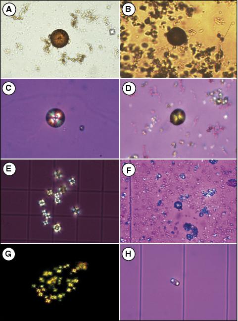 John Libbey Eurotext Annales De Biologie Clinique Lithiase De 2 8 Dihydroxyadenine Du Diagnostic A La Prise En Charge Therapeutique