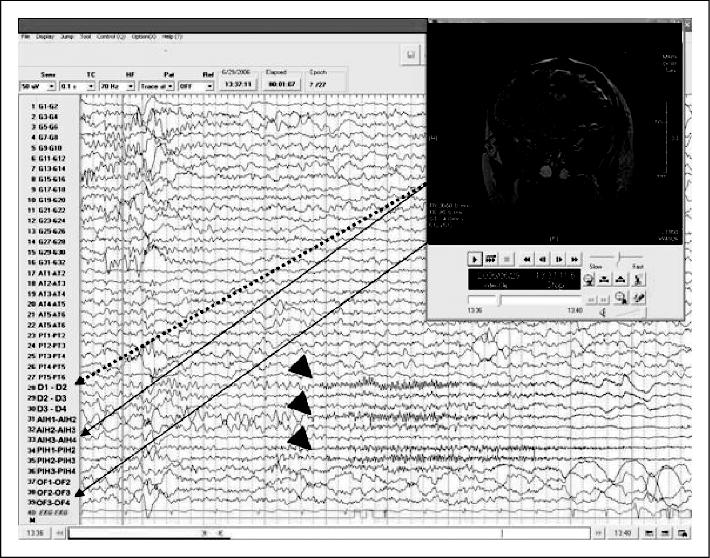 John Libbey Eurotext Epileptic Disorders Pediatric Extratemporal