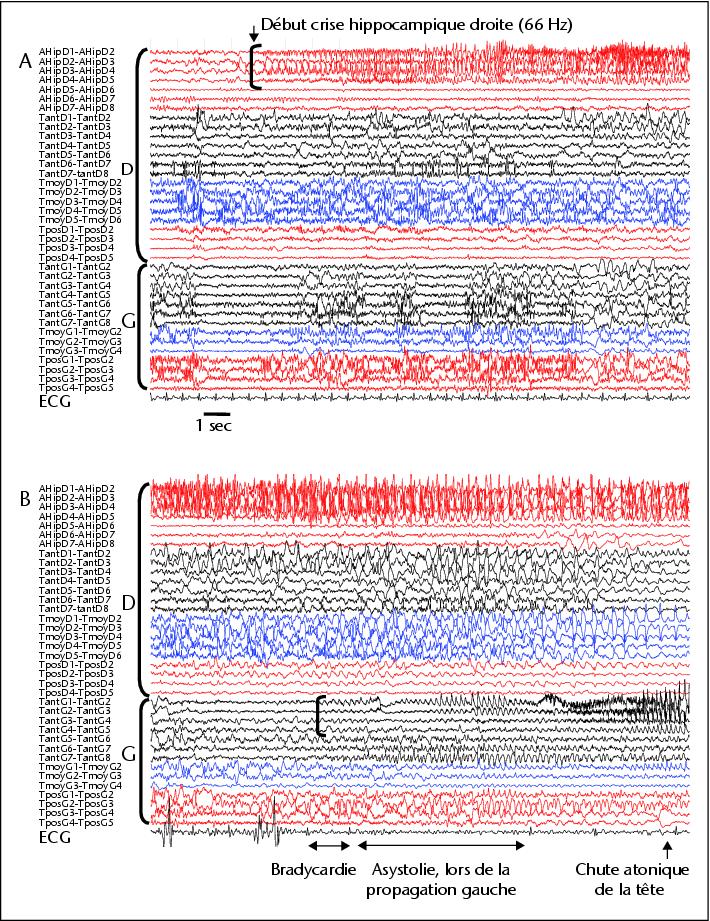 John Libbey Eurotext Epilepsies Troubles Du Rythme Cardiaque Lors Des Crises D Epilepsie