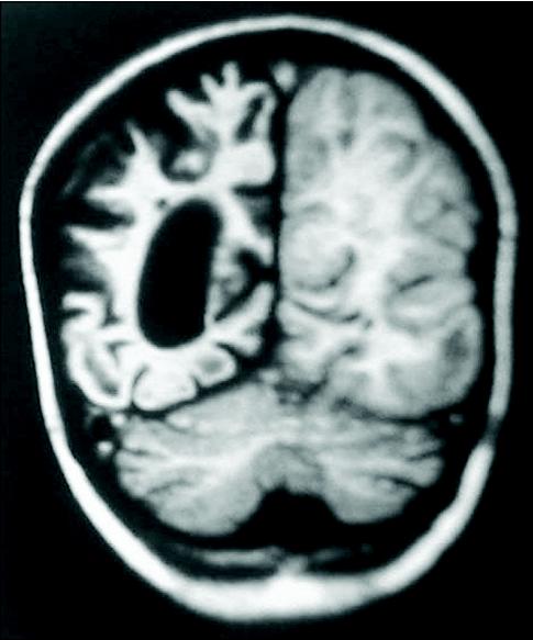 John Libbey Eurotext Epilepsies Febrile Acute Epileptic Encephalopathies In Children