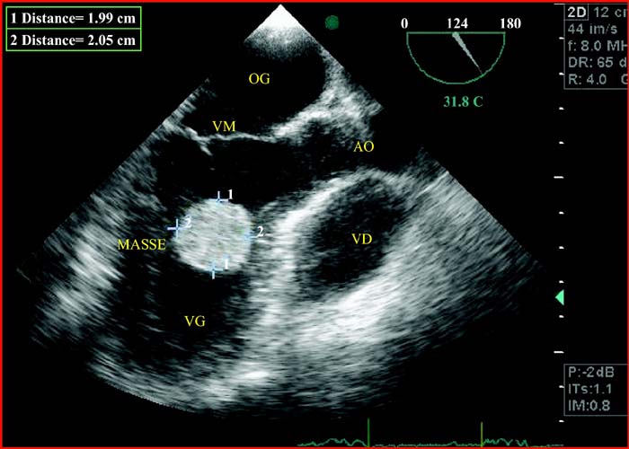 John Libbey Eurotext Sang Thrombose Vaisseaux Myxome Du Ventricule Gauche