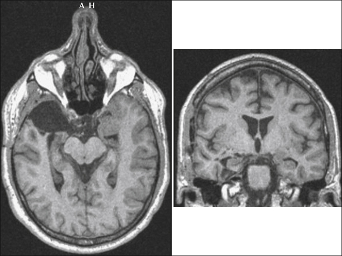 John Libbey Eurotext Epileptic Disorders Superselective Anterior