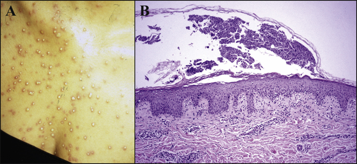 Acute Generalized Exanthematous Pustulosis Histology