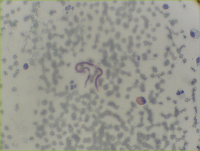 John Libbey Eurotext Medecine Et Sante Tropicales Mansonelliasis Identified By A Cervicovaginal Smear At The University Hospital Center Of Bobo Dioulasso Burkina Faso