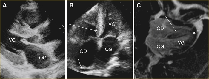 John Libbey Eurotext Medecine Et Sante Tropicales Atypical Left Ventricular Hypertrophy Revealing A Rare Cause Of Heart Failure In A Man From The Comoros Islands