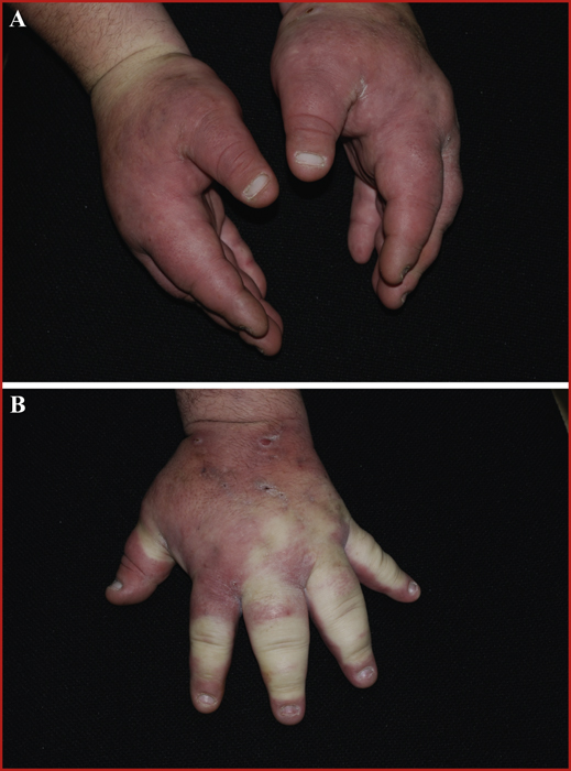 44++ Thrombose im finger bilder , Thrombose Im Finger Bilder Mondor S Disease Dieser blutpfropf