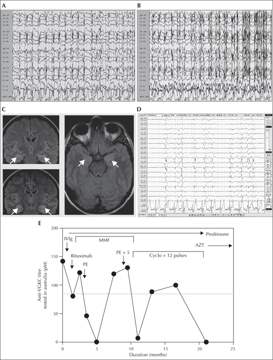 JLE - Epileptic Disorders - Myoclonic status epilepticus as a ...