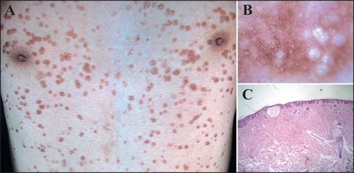 Eruptive Syringoma