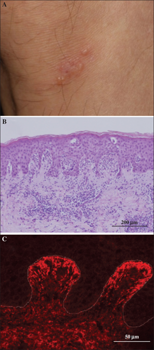 dermatitis herpetiformis histology