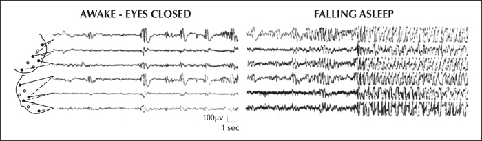 Jle Epileptic Disorders Encephalopathy Related To Status Epilepticus During Slow Sleep An