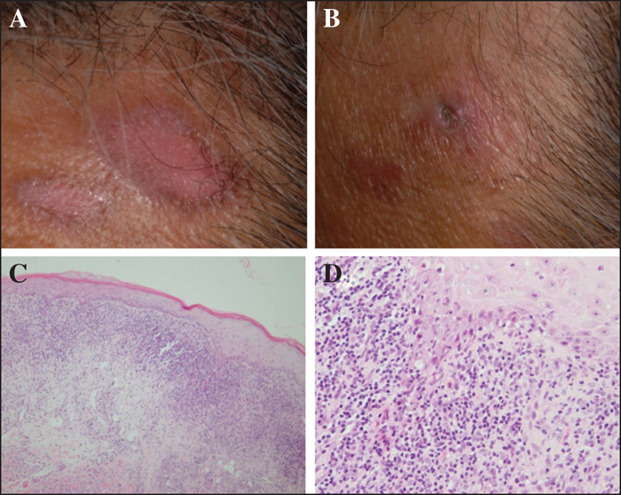 JLE - European Journal of Dermatology - A case of lichenoid drug ...