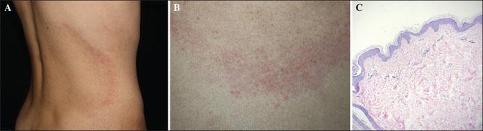 Jle European Journal Of Dermatology Squiz Your Knowledge A Recurrent Annular Erythema 0958