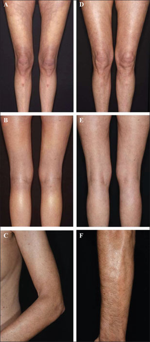 John Libbey Eurotext - European Journal of Dermatology - Response of ...