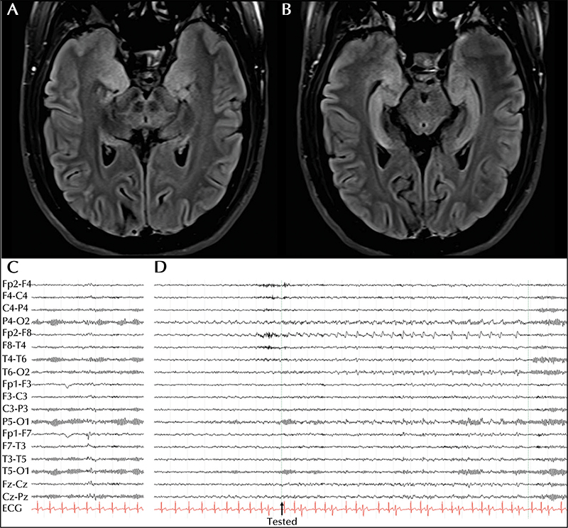 transient epileptic amnesia generalized seizure