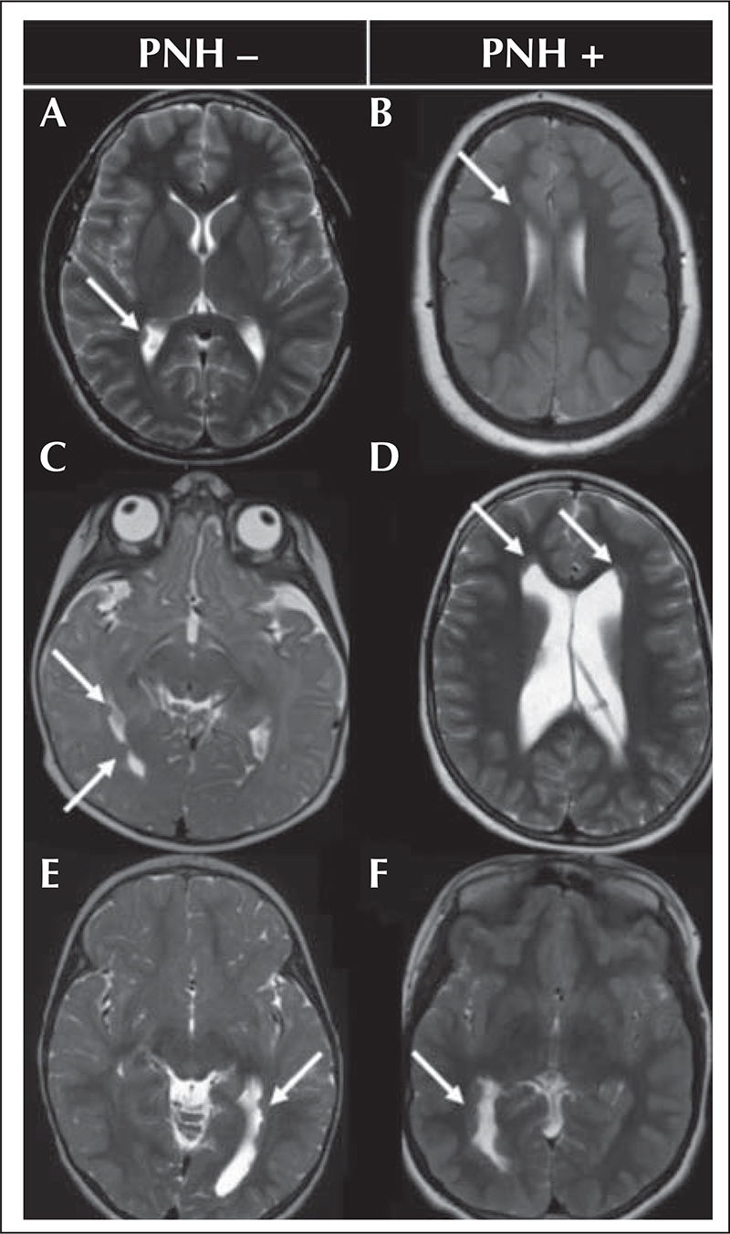 John Libbey Eurotext Epileptic Disorders Magnetic Resonance Imaging