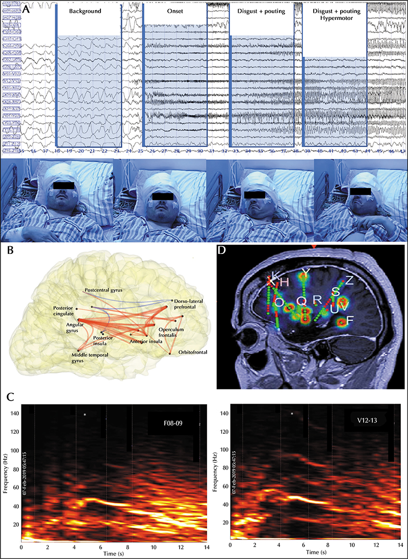 Jle Epileptic Disorders Motor And Emotional Facial Features In Parietal Lobe Seizures An