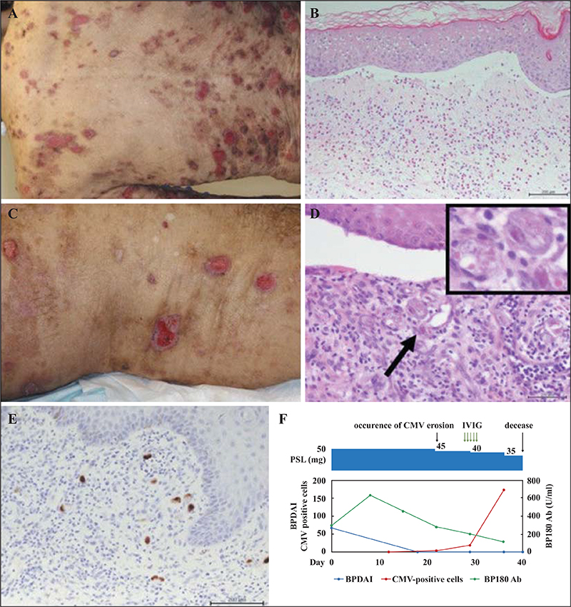 JLE - European Journal Of Dermatology - Cytomegalovirus-induced Skin ...