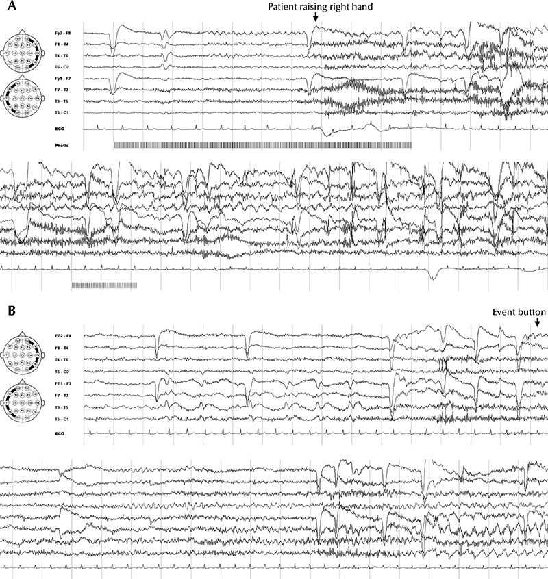 JLE - Epileptic Disorders - Autoimmune Musicogenic Bilateral Temporal ...