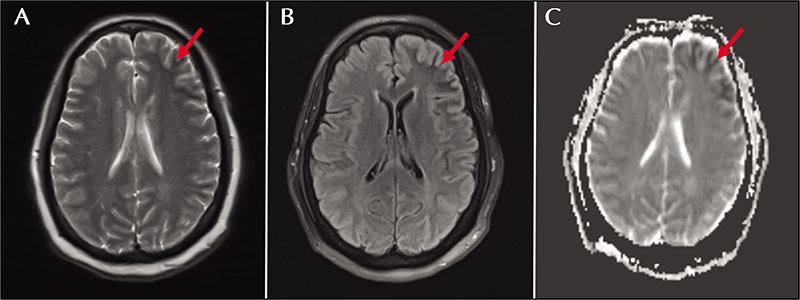 John Libbey Eurotext Epileptic Disorders Location Atypical Lesions