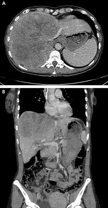 JLE - Hépato-Gastro & Oncologie Digestive - Cholangiocarcinome Intra ...