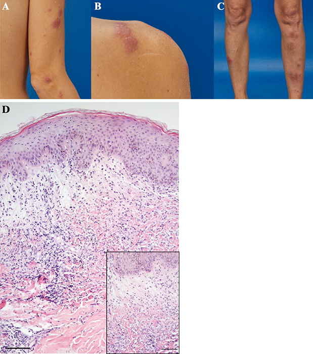 Jle European Journal Of Dermatology Concurrent Sweet Syndrome And Erythema Nodosum Two