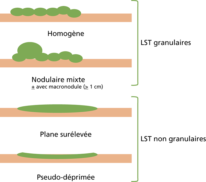 JLE Hépato Gastro Oncologie Digestive Caractérisation endoscopique des polypes coliques