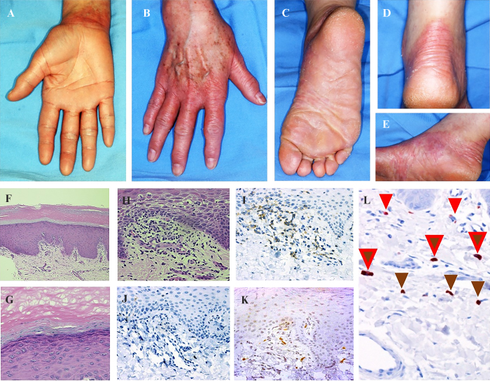 JLE - European Journal of Dermatology - Nagashima-type palmoplantar ...