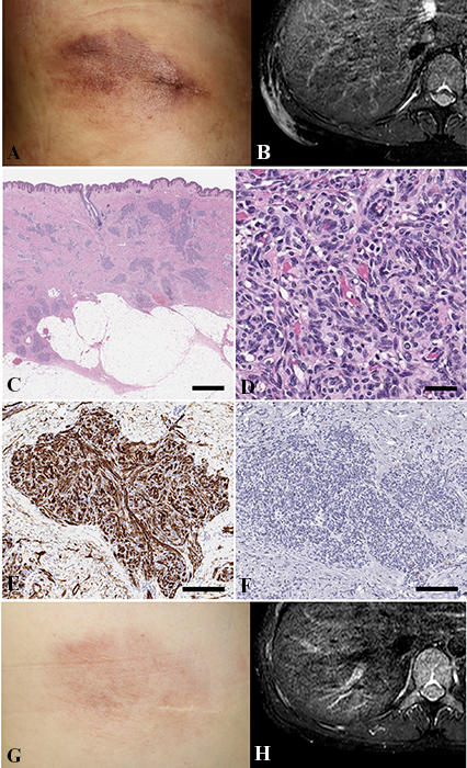 JLE - European Journal of Dermatology - Acquired tufted angioma with ...